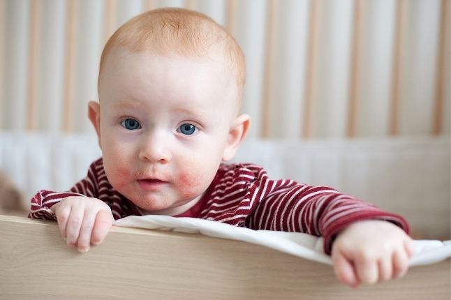 alergia na mleko u niemowlaka objawy